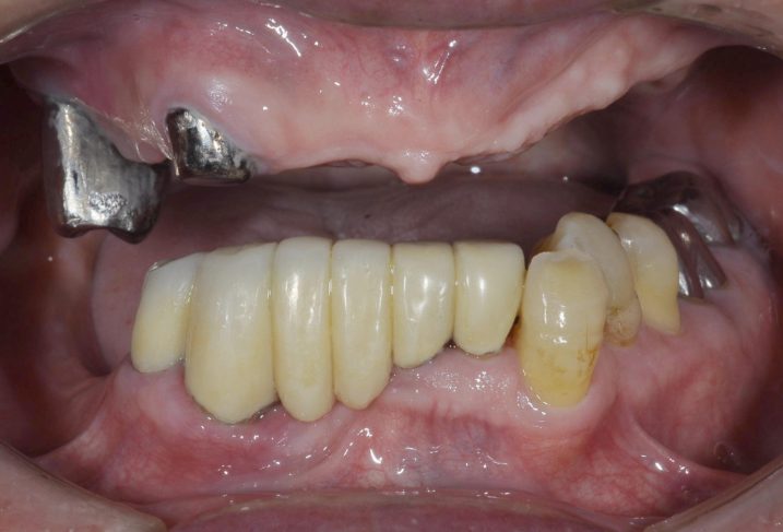 義歯　インプラント　歯周外科　矯正治療を行う前の写真