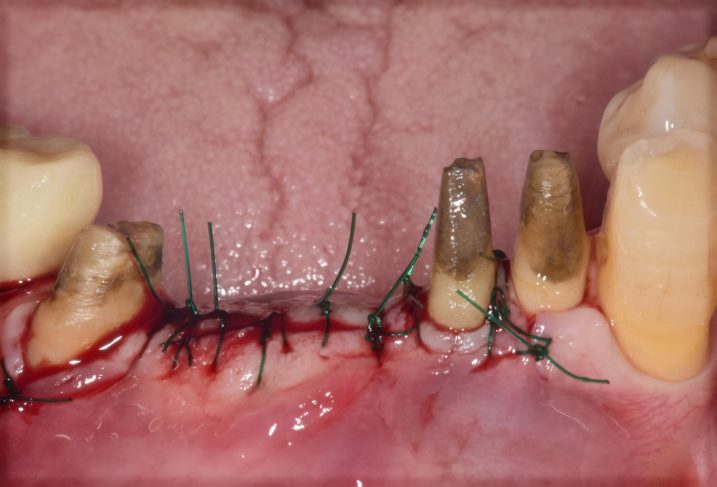 下顎前歯インプラント手術後の写真