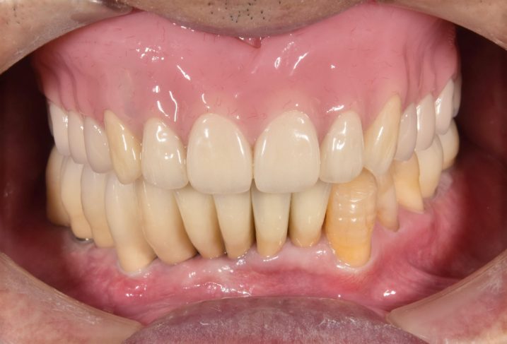 義歯　インプラント　歯周外科　矯正治療を終えた後の写真