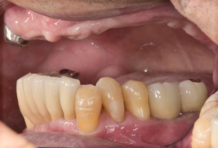 義歯　インプラント　歯周外科　矯正治療を終えた後の写真