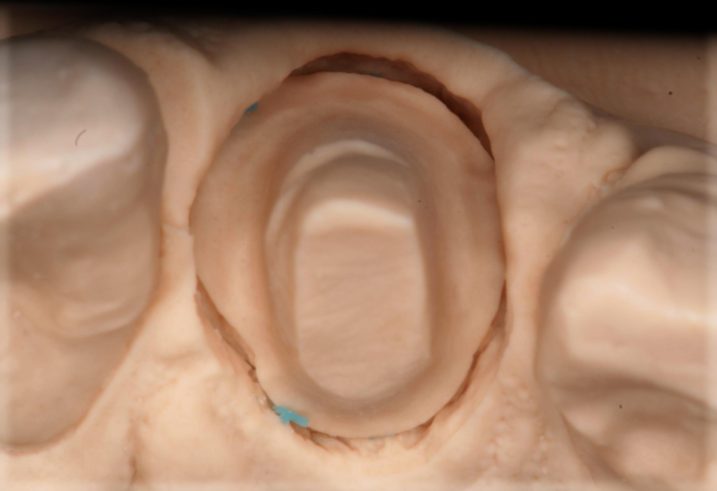 セラミック冠を用いた治療を行う為に作成支台歯模型