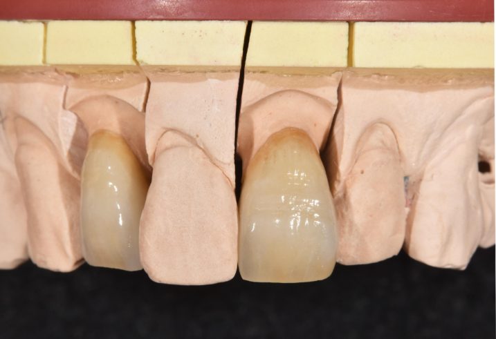 セラミック冠を用いた治療を行う為に作成支台歯模型と、作成したセラミック冠