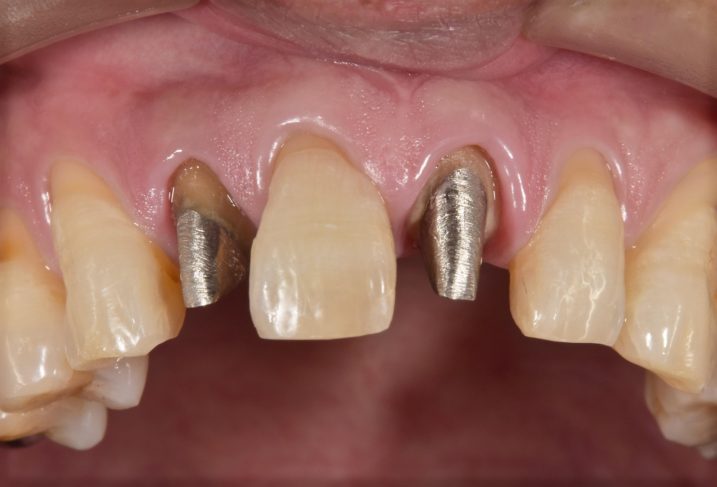 セラミック治療のための支台歯形成