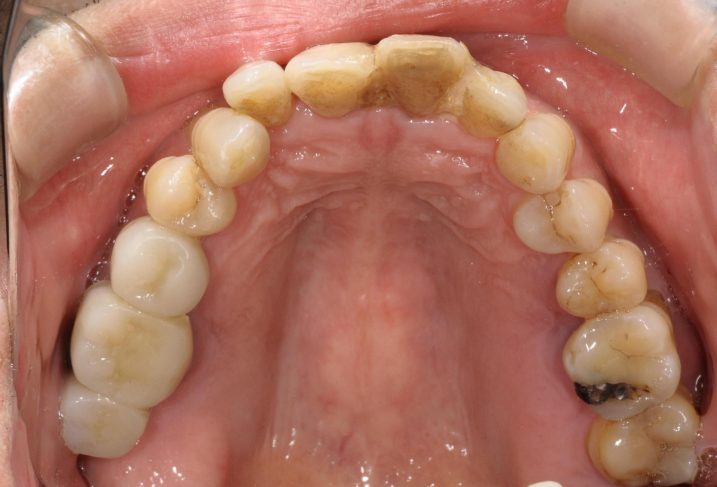 歯周病に対してセラミック・インプラントを用いて審美歯科治療を行う前の写真