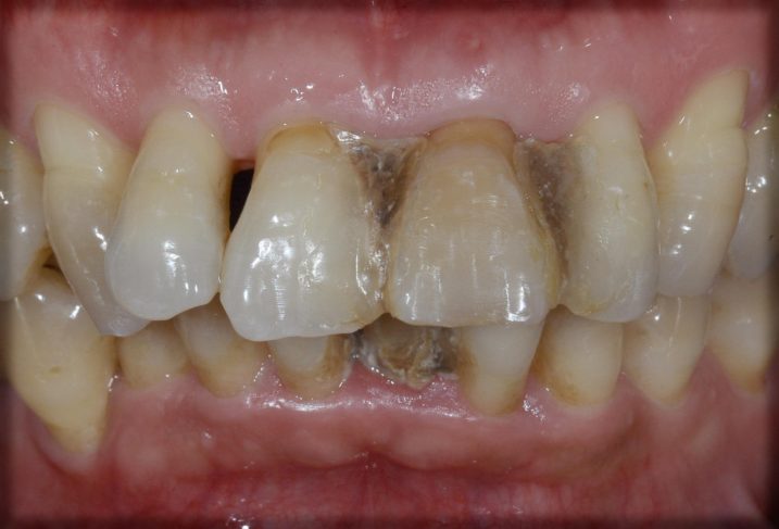 歯周病に対してセラミック・インプラントを用いて審美歯科治療を行う前の写真