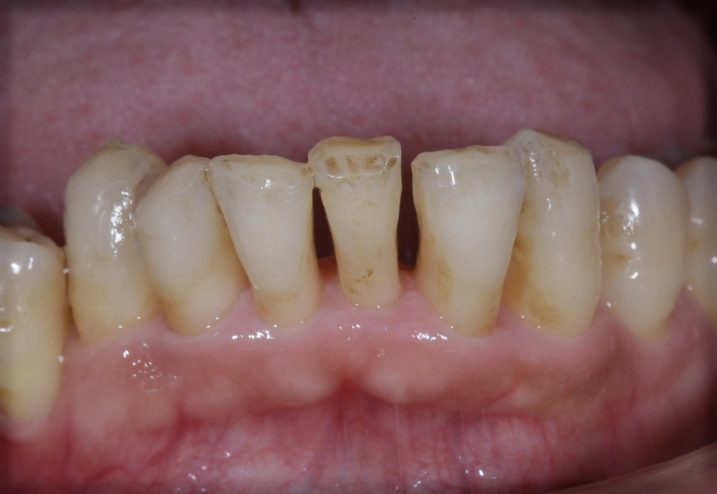歯周病に対してセラミック・インプラントを用いて審美歯科治療を行っている間の写真