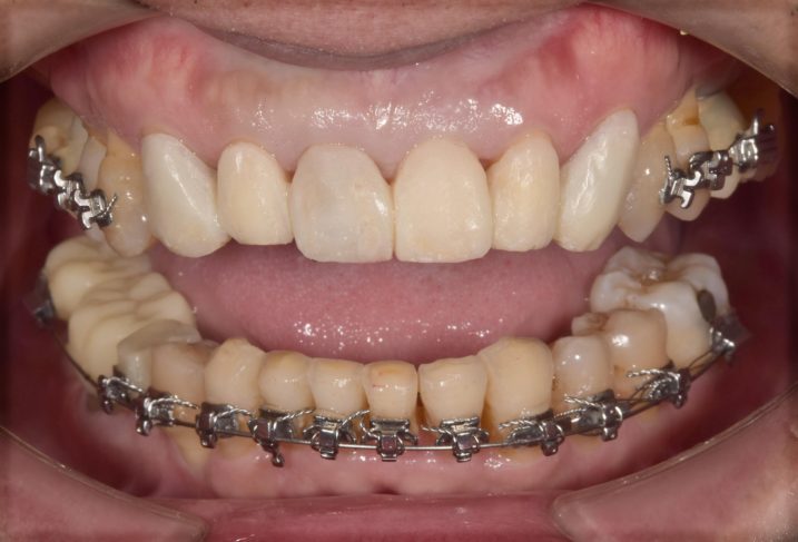 歯周病の手術後、矯正治療中の写真