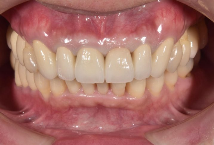 歯周病に対してセラミック・インプラントを用いて審美歯科治療を行った後の写真