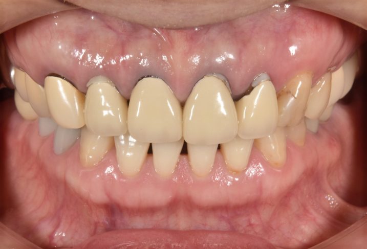 上顎前歯部にセラミックを用いて審美歯科治療を行う前の写真