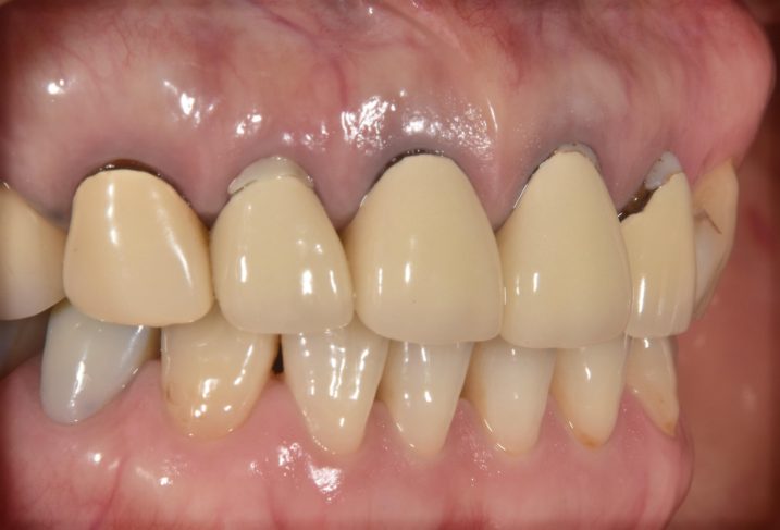 上顎前歯部にセラミックを用いて審美歯科治療を行う前の写真