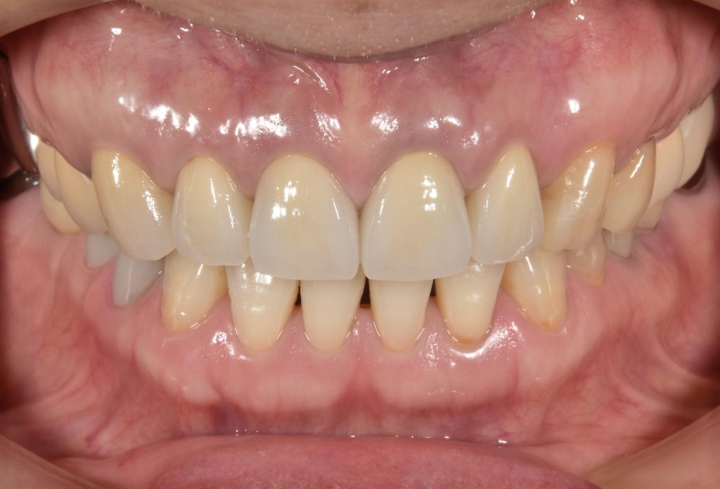 上顎前歯部にセラミックを用いて審美歯科治療を行った後の写真